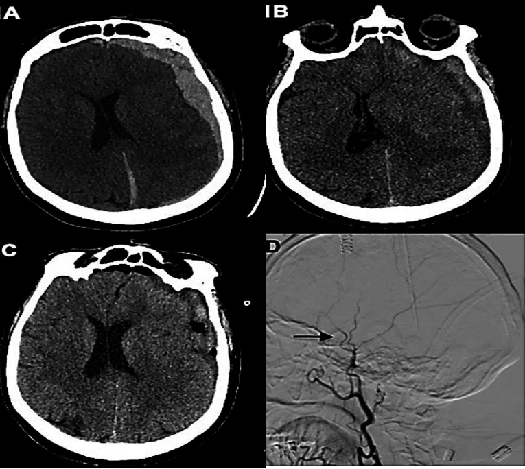 Acute subdural haemorrhage in a warfarin user following leech bite: Clinical note and review.