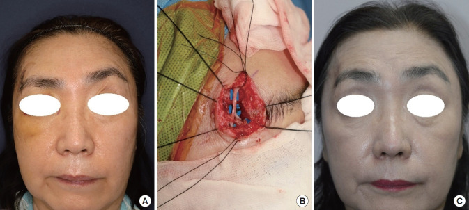 Sural nerve grafts in subacute facial nerve injuries: a report of two cases.