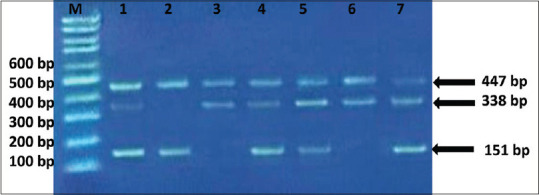 Association of Fibroblast Growth Factor-1 Promoter Polymorphism and its Serum Concentrations with Repeated Implantation Failure after <i>In vitro</i> Fertilisation: A Cross-sectional Study.