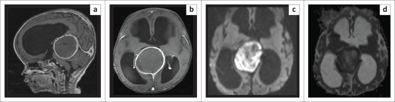 Chemical abscess post vein of Galen aneurysmal malformation embolisation with ethylene vinyl alcohol copolymer.