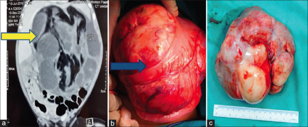 Gastric Teratoma in Children: A Report of Two Cases and Review of Literature.