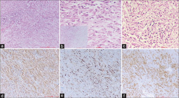 Inflammatory Myofibroblastic Tumour in Children: A Report of Two Cases and Review of Literature.