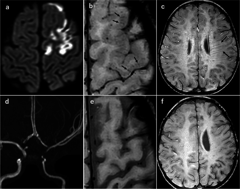 Cortical Brush Sign: A Novel Finding on Thin-slice 3T Susceptibility-weighted Imaging in Acute Cerebral Infarct and Cerebral Venous Thrombosis.