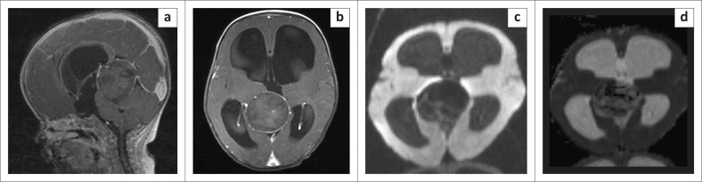 Chemical abscess post vein of Galen aneurysmal malformation embolisation with ethylene vinyl alcohol copolymer.