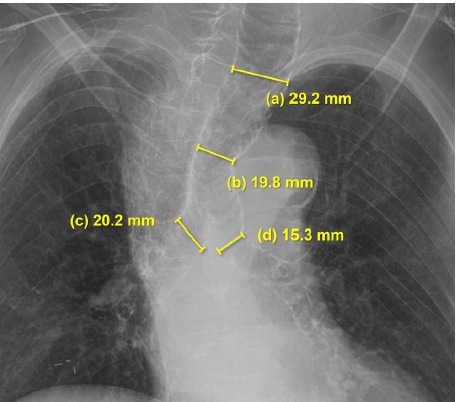 Airway management of a patient with Mounier-Kuhn syndrome during general anesthesia - A case report.