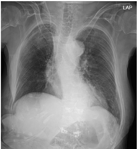 Airway management of a patient with Mounier-Kuhn syndrome during general anesthesia - A case report.