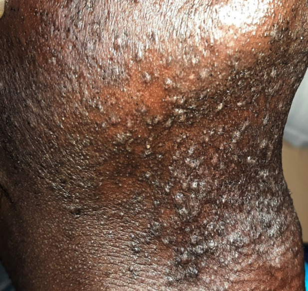 [Pseudofolliculitis barbae in police students in Dakar: epidemiological and clinical aspects, and associated risk factors].