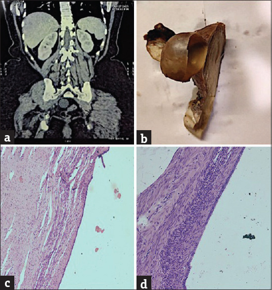 Uterine Serous Cystadenoma or Endosalpingiosis?: A Case Report with a Review of Literature.