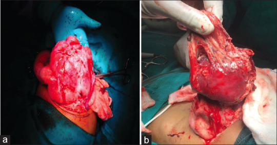 Inflammatory Myofibroblastic Tumour in Children: A Report of Two Cases and Review of Literature.