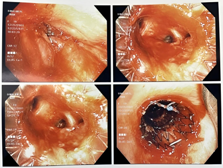 Diffuse Large B-cell Lymphoma Presenting as Bronchial Mass.