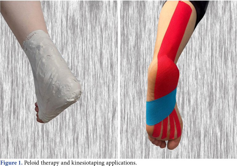 Comparison of the effectiveness of peloid therapy and kinesiotaping in patients with unilateral plantar fasciitis: A prospective, randomized controlled study.