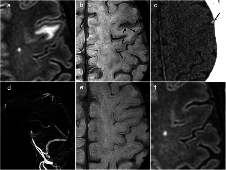 Cortical Brush Sign: A Novel Finding on Thin-slice 3T Susceptibility-weighted Imaging in Acute Cerebral Infarct and Cerebral Venous Thrombosis.