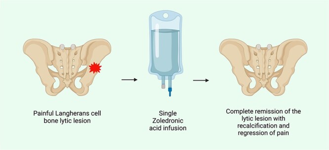 Complete remission after a single bisphosphonate infusion in isolated bone Langerhans cell histiocytosis lesion: a case report and a narrative review of the literature.
