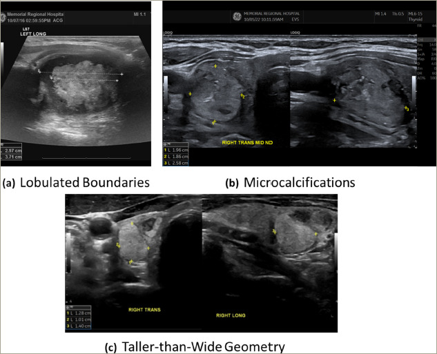 Challenges in Risk Stratification of Solid Atypical Mixed Echogenicity Thyroid Nodules.