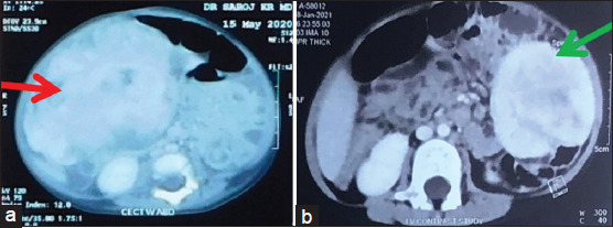 Inflammatory Myofibroblastic Tumour in Children: A Report of Two Cases and Review of Literature.
