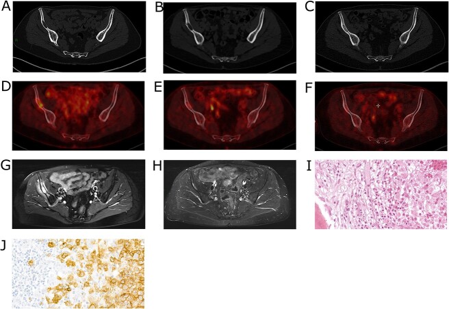 Complete remission after a single bisphosphonate infusion in isolated bone Langerhans cell histiocytosis lesion: a case report and a narrative review of the literature.