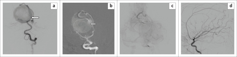 Chemical abscess post vein of Galen aneurysmal malformation embolisation with ethylene vinyl alcohol copolymer.