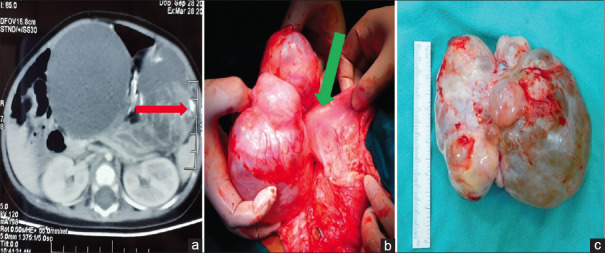 Gastric Teratoma in Children: A Report of Two Cases and Review of Literature.