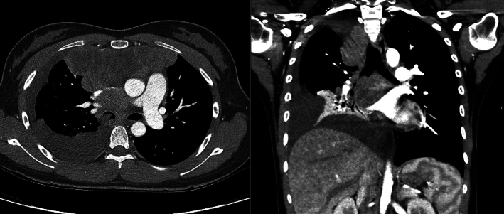 Diffuse Large B-cell Lymphoma Presenting as Bronchial Mass.