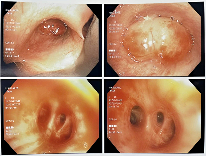 Diffuse Large B-cell Lymphoma Presenting as Bronchial Mass.