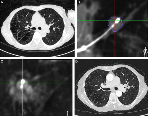 Transbronchial Microwave Ablation of Peripheral Lung Tumors: The NAVABLATE Study.