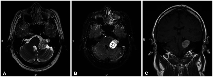 Spontaneous Regression of a Large Vestibular Schwannoma: Is Nonoperative Management Reasonable?