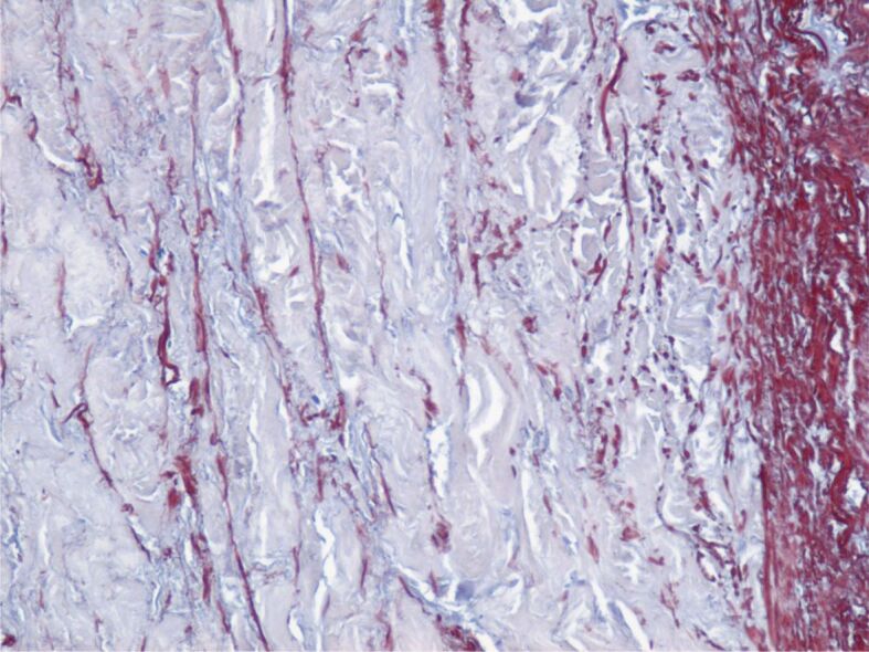 Aortic aneurysms in patients with atherosclerotic coronary artery disease in the southwestern region of Romania - clinical and histopathological study.