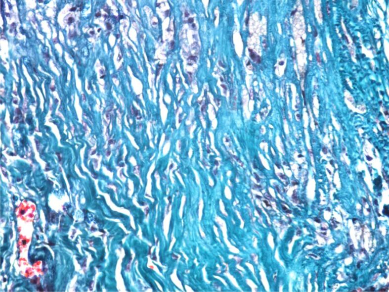 Aortic aneurysms in patients with atherosclerotic coronary artery disease in the southwestern region of Romania - clinical and histopathological study.