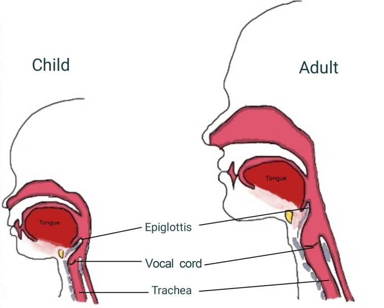 Nasotracheal intubation in pediatrics: a narrative review.