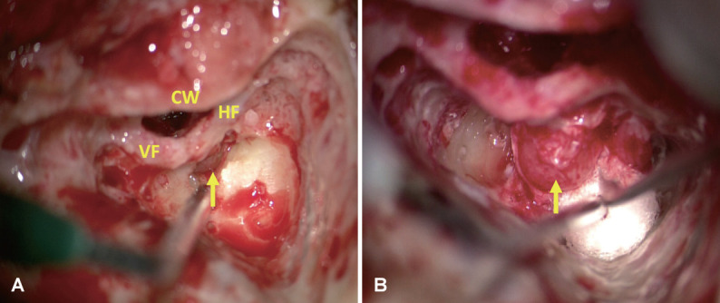 Translabyrinthine Excision of a Transmodiolar Intralabyrinthine Schwannoma Mimicking Meniere's Disease: A Case Report.