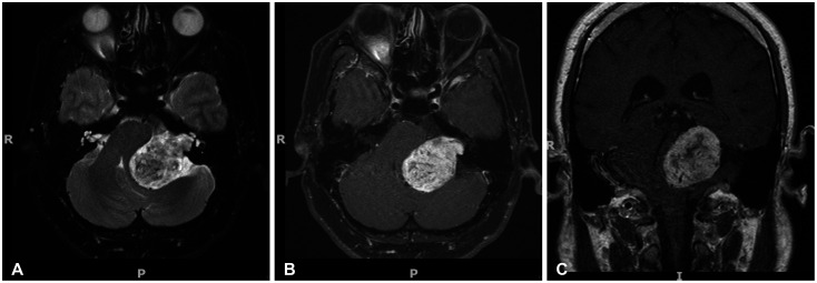 Spontaneous Regression of a Large Vestibular Schwannoma: Is Nonoperative Management Reasonable?