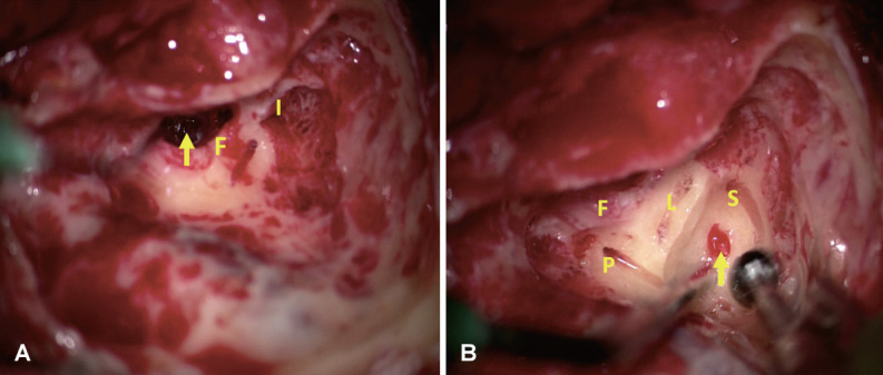 Translabyrinthine Excision of a Transmodiolar Intralabyrinthine Schwannoma Mimicking Meniere's Disease: A Case Report.