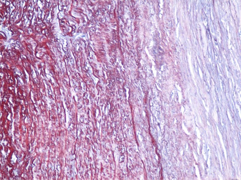 Aortic aneurysms in patients with atherosclerotic coronary artery disease in the southwestern region of Romania - clinical and histopathological study.
