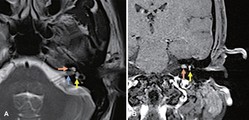 Translabyrinthine Excision of a Transmodiolar Intralabyrinthine Schwannoma Mimicking Meniere's Disease: A Case Report.