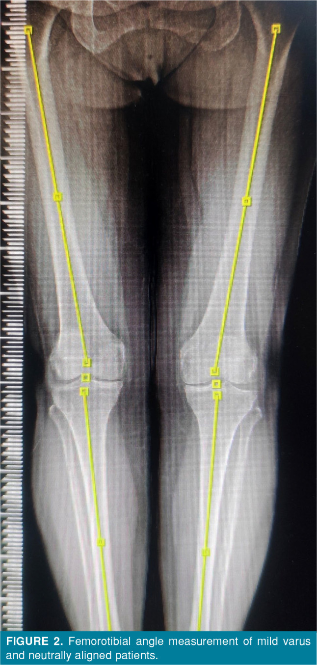 Impact of postoperative femorotibial axis on functional outcomes in unicompartmental knee arthroplasty.