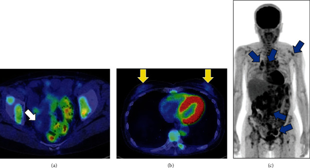 A Case Report of Occult Breast Cancer Detected by Diagnostic Laparoscopy for Suspected Ovarian Cancer.