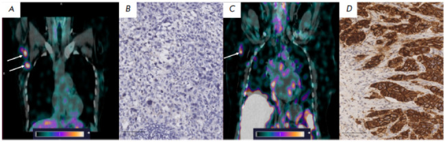 Evaluation of HER2/neu Expression in Metastatic Axillary Lymph Node Tissue of Breast Cancer Patients Using [99mTc]Tc-(HE)3-G3.