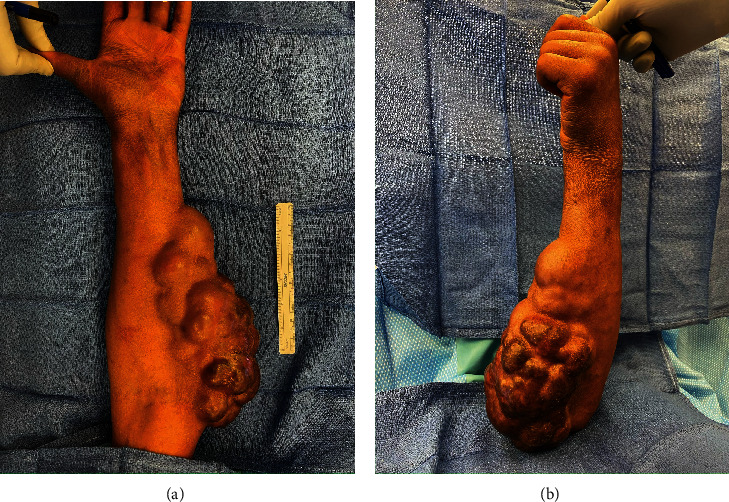 The Role of Surgery to Relieve Symptomatic Cutaneous T-Cell Lymphoma Refractory to Medical Treatments.