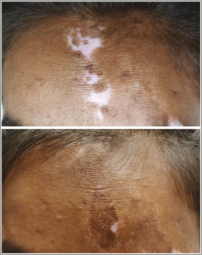Noncultured epidermal suspension procedure of vitiligo surgery using freeze-dried trypsin coated on silicon pellets.
