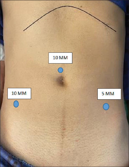 Comparison of single absorbable tacker vs. conventional method in fixating the mesh in bilateral inguinal hernia undergoing laparoscopic transabdominal preperitoneal (TAPP): A randomized control trial study.