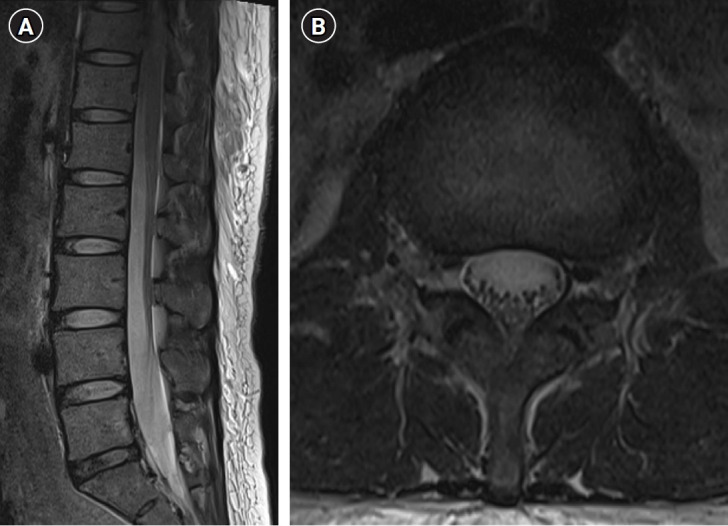 Unintended subdural anesthesia and subdural air bubbles after attempted epidural anesthesia in a patient undergoing cesarean section.