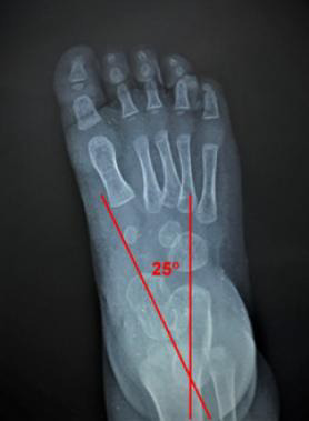 CURRENT LINES AND ANGLES USED IN PAEDIATRIC FOOT RADIOGRAPH: A SCOPING REVIEW OF LITERATURE.