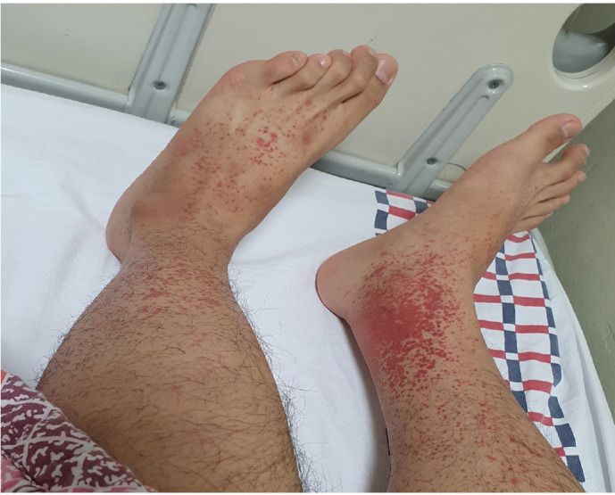 Henoch-Schönlein purpura following mRNA COVID-19 vaccination: a case report.