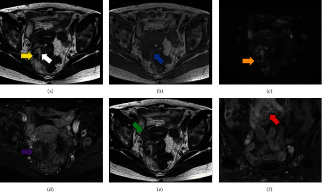 A Case Report of Occult Breast Cancer Detected by Diagnostic Laparoscopy for Suspected Ovarian Cancer.