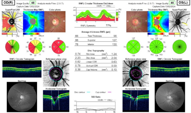 Atypical Presentation of Foster Kennedy Syndrome due to Neurocysticercosis: A Rare Case Report.