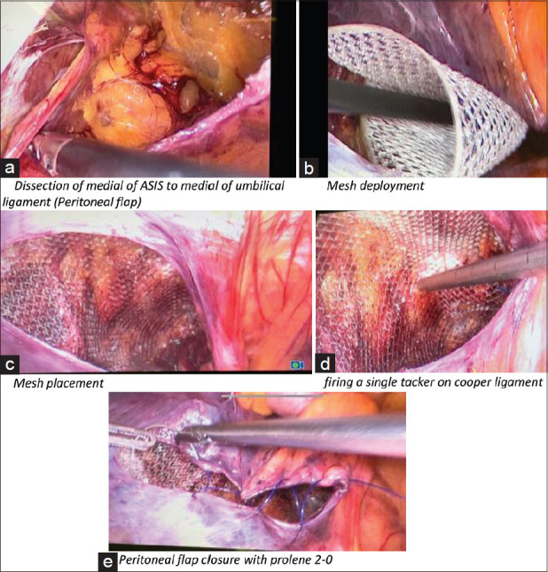 Comparison of single absorbable tacker vs. conventional method in fixating the mesh in bilateral inguinal hernia undergoing laparoscopic transabdominal preperitoneal (TAPP): A randomized control trial study.