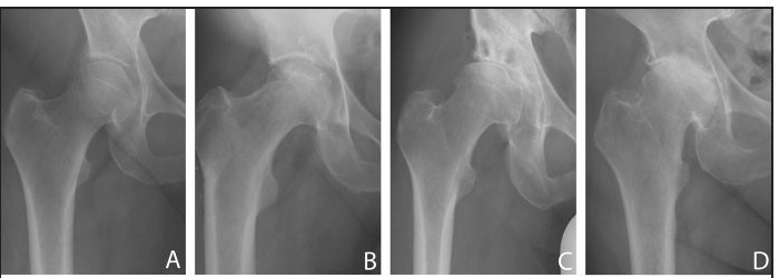 Hip Osteoarthritis-Clinical-Statistical Study and Surgical Treatment.