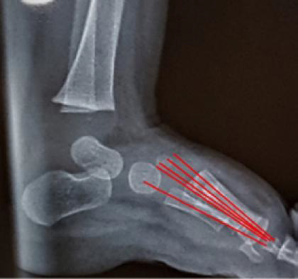 CURRENT LINES AND ANGLES USED IN PAEDIATRIC FOOT RADIOGRAPH: A SCOPING REVIEW OF LITERATURE.