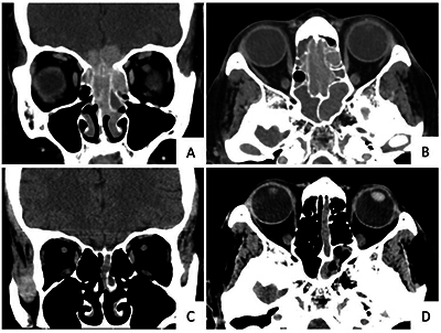 Olfactory Neuroblastoma Is Not Always Located at the Roof of the Nasal Cavity.