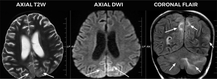 Posterior reversible encephalopathy syndrome in immunocompromised children - A single-center study from South India.